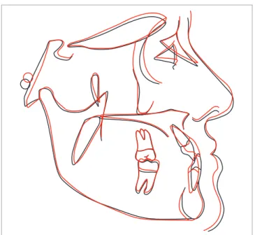 Figure 11 - Initial (black) and final (red) cephalometric tracings superimposition.