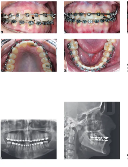 Figure 17 -  Radiographs at treatment comple- comple-tion: A) Panoramic; B) Profile radiograph.