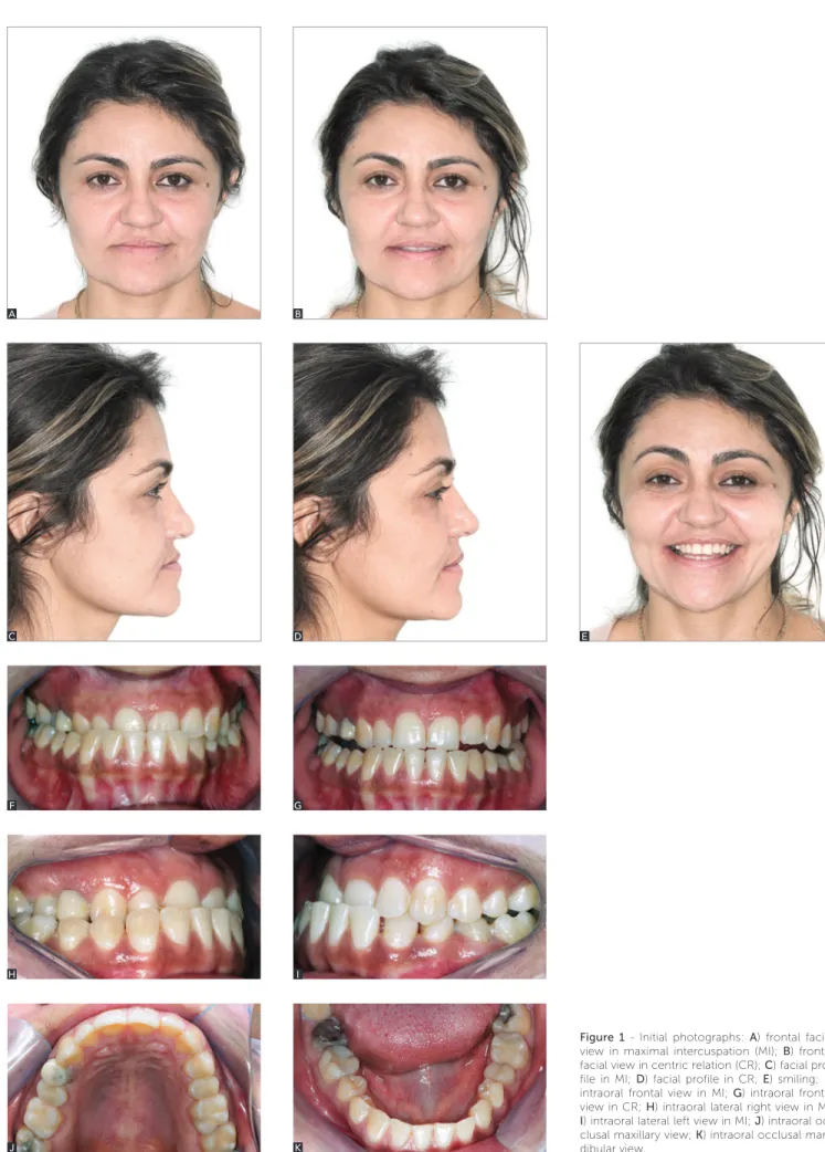 Figure 1 -  Initial photographs: A) frontal facial  view in maximal intercuspation (MI); B) frontal  facial view in centric relation (CR); C) facial  pro-file in MI; D) facial propro-file in CR; E) smiling; F)  intraoral frontal view in MI; G) intraoral fr