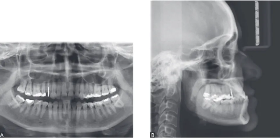 Figure 2 - Acrylic resin device used for occlusal  fixation in CR.