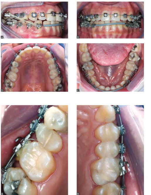 Figure 5 - Photographs depicting right and left  maxillary quadrants, highlighting stops  place-ment and the use of elastic ligatures.
