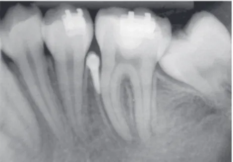 Figure 5 - Mini-implant loss.
