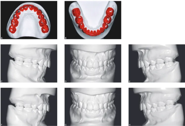 Figure 5 - A, B) An occlusal analysis is done initially on CR mounted models before the occlusal equilibration is carried out on the patient