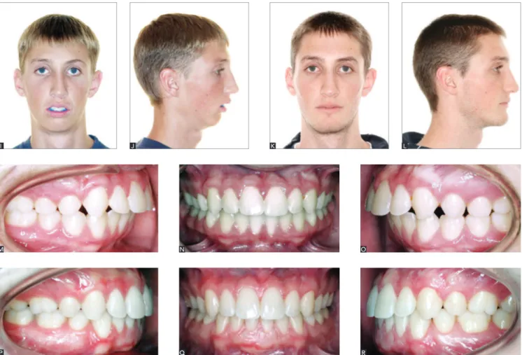 Figure 5 (II) - Pre-treatment (I, J; M, N, O) and post-treatment facial photographs (K, L; P, Q, R) of the same patient shown in Figures 5A to 5H