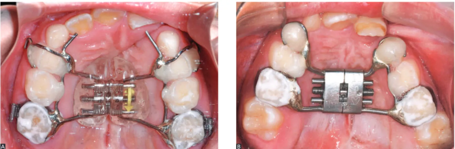 Figure 1 - Occlusal photographs of two patients from the sample illustrating both expanders: Modified Haas (A) and Hyrax (B)