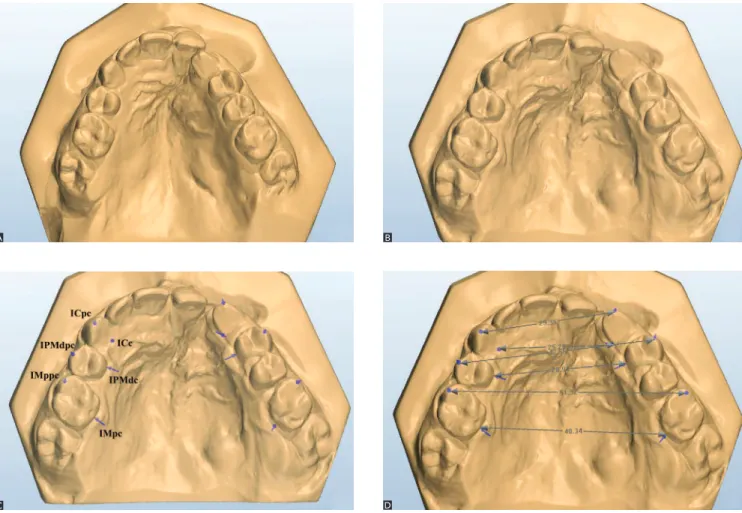 Figure 2 - Initial and final digital models showing the results of rapid maxillary expansion (A and B); reference points (C) and measurements made (D) on post- post-expansion models