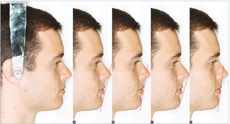 Figure 2 - Reference lines - A) Steiner S line; B) Holdaway H line; C) Ricketts E line D) Burstone B line.