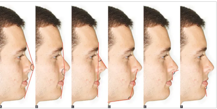 Figure 3 - Angular measurements and reference lines: A) Total facial convexity angle (G’.Pn.Pg’); B) Facial convexity angle (G’.Sn.Pg’); C) Nasofacial angle  (G’-Pg’.N’-Pn);  D) Lower third angle (Sn.Me’.C); E) Nasolabial angle (UL.Sn.Co);F) Mentolabial an