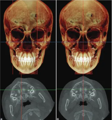 Figure 1 - A) Example of a patient with the Frankfort Horizontal Plane hori- hori-zontally oriented