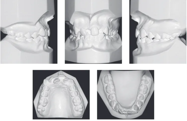 Figure 2 - Initial casts.