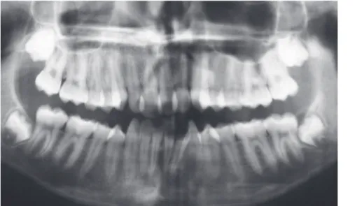 Figure 3 - Initial panoramic and periapical radiographs of incisors.