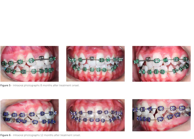 Figure 5 - Intraoral photographs 8 months after treatment onset.