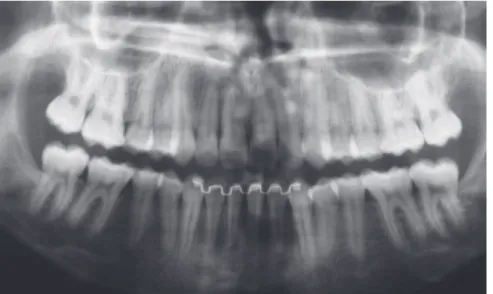 Figure 10 - Control periapical radiograph  of tooth #41 six months after endodontic  treatment.