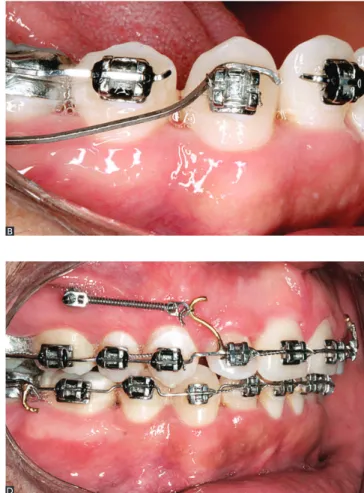 Figure 18 - Mechanical illustration of forces and moments in the segmented  arch technique employed for simultaneous retraction and intrusion of  incisors.