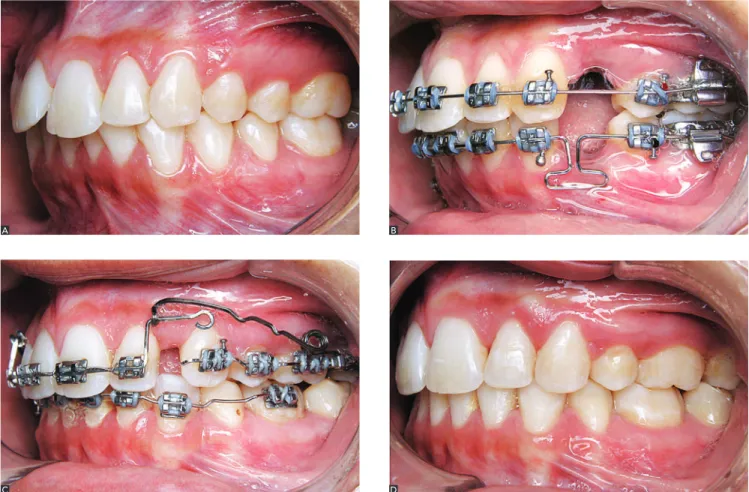 Figure 19 - Clinical illustration of SAT used for simultaneous retraction and intrusion of incisors:(A) initial case; (B) during maxillary alignment and leveling; (C) deep bite  after alignment and leveling completion, and partial retraction of canines; (D