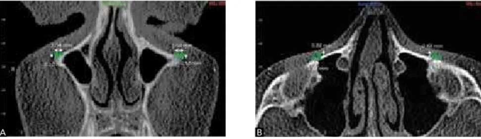 Figure 18 - Midpalatal suture movements in X and   Z planes (axial slice).