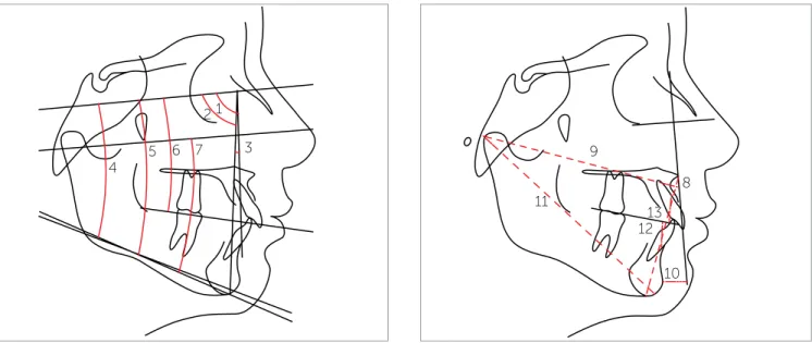 Figure 3 - Skeletal angular cephalometric measurements: 1) SNA; 2) SNB; 