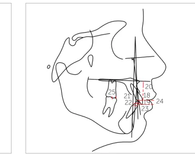 Figure 5 - Angular dental cephalometric measurements: 14) 1.NA; 15) 1.PP; 