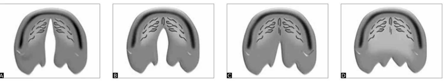 Figure 1 - Complete cleft palate invariably extends from the incisive foramen to the uvula (A)