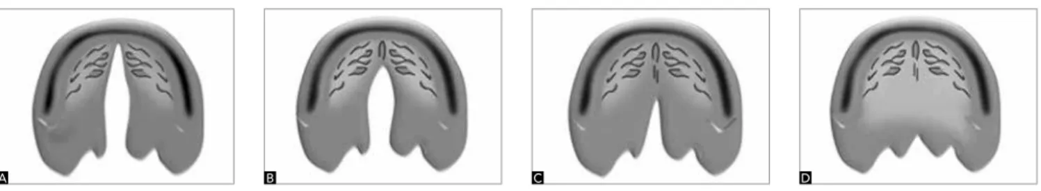 Figure 1 - Complete cleft palate invariably extends from the incisive foramen to the uvula (A)