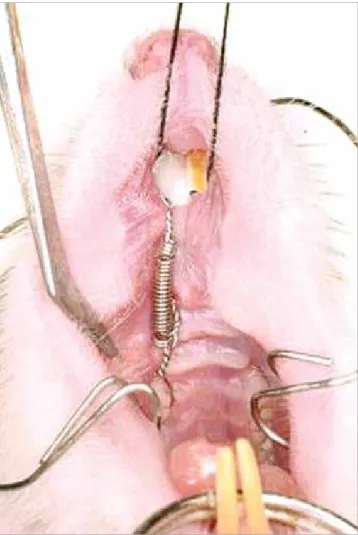 Figure 1 - Tooth movement device proposed by Heller and Nanda. 17 Extended coil (50 cN).