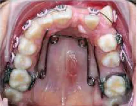 Figure 7 - Hilgers appliance properly installed. Figure 8 - Quad-helix appliance installed to main- main-tain distalization of #26.