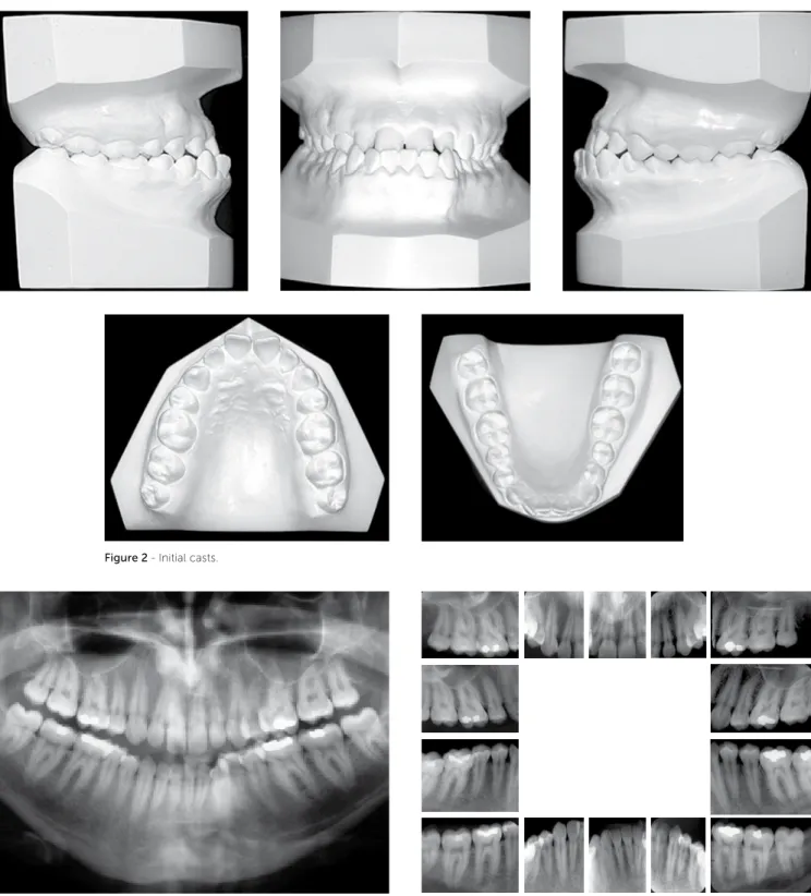 Figure 2 - Initial casts.