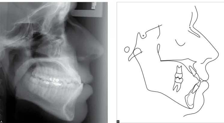 Figure 5 - A) Initial cephalometric profile radiograph and B) cephalometric tracing.