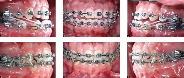 Figure 7 - Increased vertical dimension during retraction of mandibular anterior teeth (A, B, C) and treatment completion phase (D, E, F).