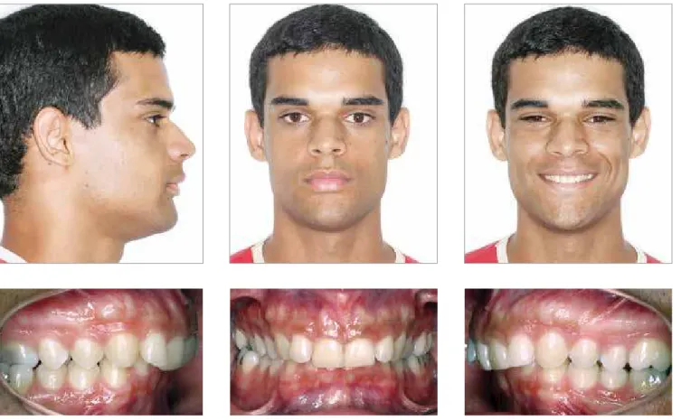 Figure 5 - Initial facial and intraoral photographs.