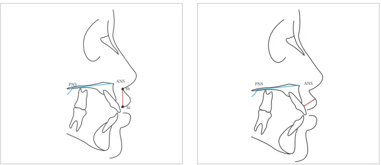 Figure 3 - Measure of upper lip height (plane passing through subnasale and  stomion superius)