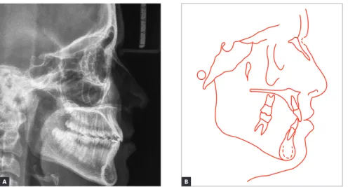 Figure 18 - Final lateral cephalogram (A) and  cephalometric tracing (B).