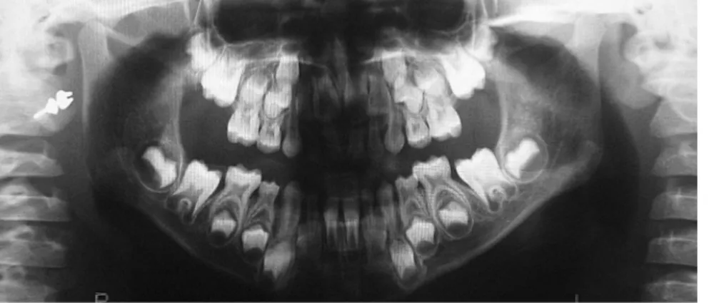 Figure 3 - Initial panoramic radiograph. Figure 4 - Initial occlusal radiograph of the maxilla.