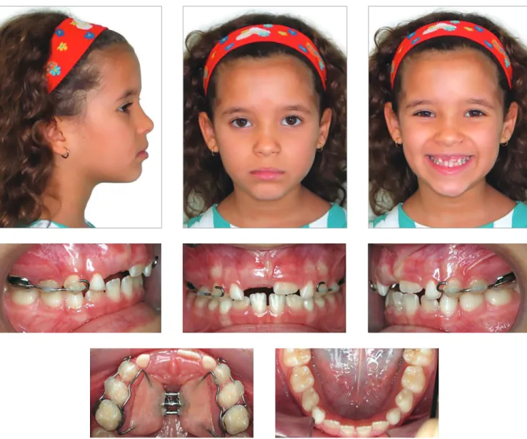 Figure 7 - Facial and intraoral photographs at first treatment phase completion, immediately before re- re-moval of the Haas appliance.