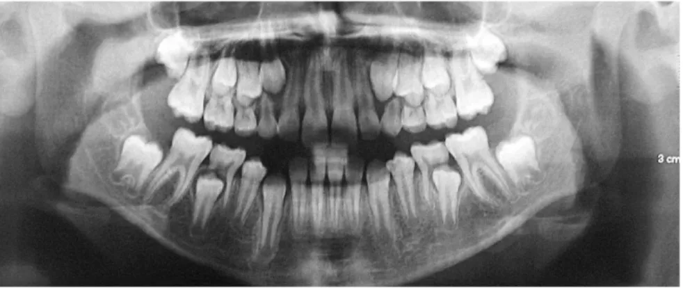 Figure 11 - Panoramic radiograph at 11 years  and one month old.