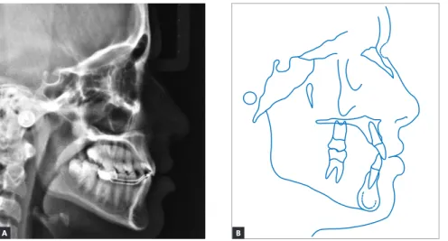 Figure 14 - Lateral cephalogram (A) and cepha- cepha-lometric tracing (B) at second phase of  treat-ment onset.