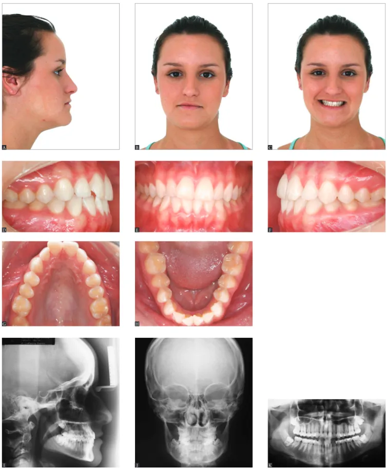 Figure 8 - Class I mature patient with asymmetry evinced by lateral deviation of the chin, in addition to vertical difference in leveling between lip commissures  and inclination of the occlusal plane in frontal view
