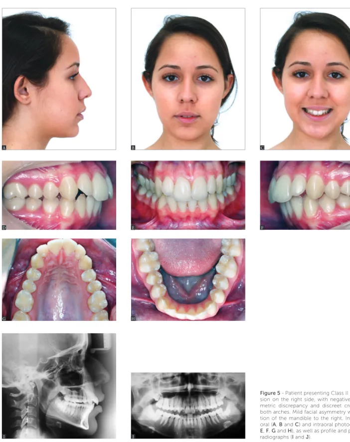 Figure 5 - Patient presenting Class II malocclu- malocclu-sion on the right side, with negative  cephalo-metric discrepancy and discreet crowding in  both arches