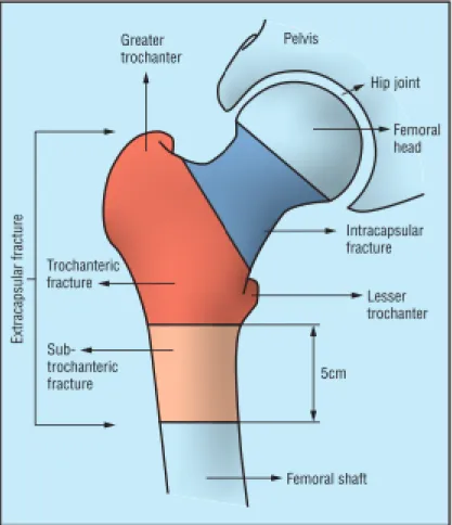 Figure 1: Classification of hip fractures. Reproduced from Parker and Johansen, 2006 [1] 