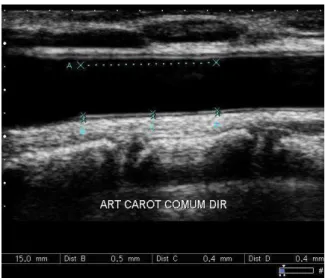 FIGURA 1 - Corte longitudinal da artéria carótida comum direita com as três medidas  da EMIC no trecho de 15 mm abaixo do bulbo, pelo método caliper