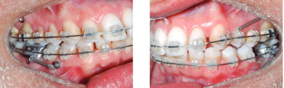 Figure 3 - Fixed appliance is required to control the tendency towards molar rotation.