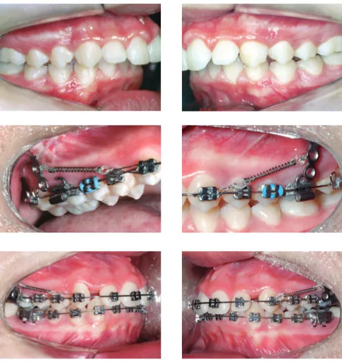 Figure 5 - Bilateral Class II malocclusion patient using mini plates with force vectors in horizontal or  vertical direction