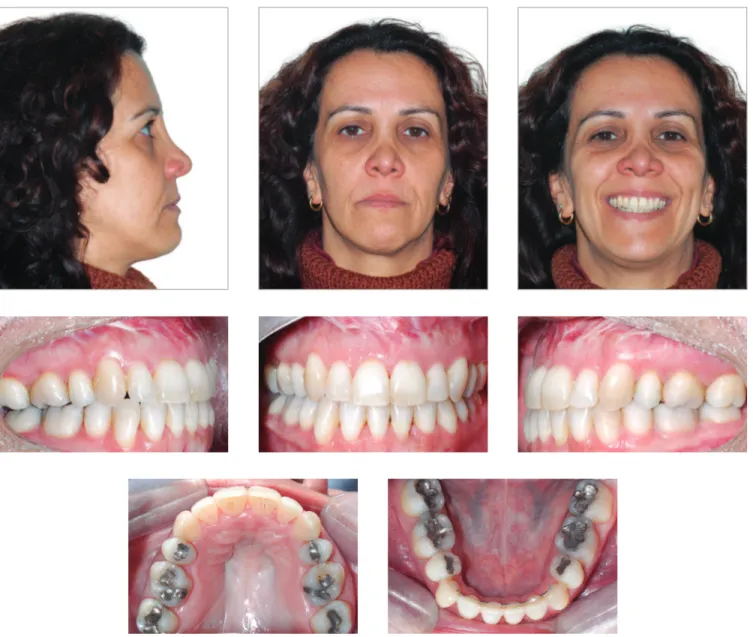 Figure 7 (continuation) - Patient subject to orthodontic treatment with the aid of tooth-borne distrac- distrac-tors in the maxilla and the mandible