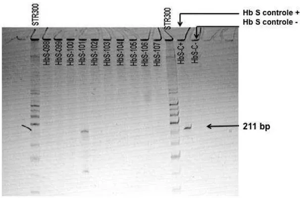 Figura 9: PCR para detecção do alelo S em crianças triadas no PETN-MG.  Gel  de  poliacrilamida  corado  com  prata  mostrando  a  presença  do  alelo  S  em  apenas uma amostra (HbS101), além do controle positivo