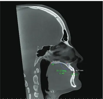 Figure 6 - Sagittal slice with the individual’s head positioned so as the hori- hori-zontal reference line was superimposed to the palatal plane, for  measure-ment of maxillary right central incisor inclination after orthodontic  decom-pensation.