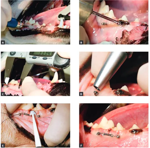 Figure 3 - Photographs illustrating the steps for  mini-implant placement: A) Initial mini-implant  placement with manual key; B) Conclusion of  placement with torque wrench; C)  Measure-ment of inter mini-implant distance; D) Use  of Periotest; E) Measure