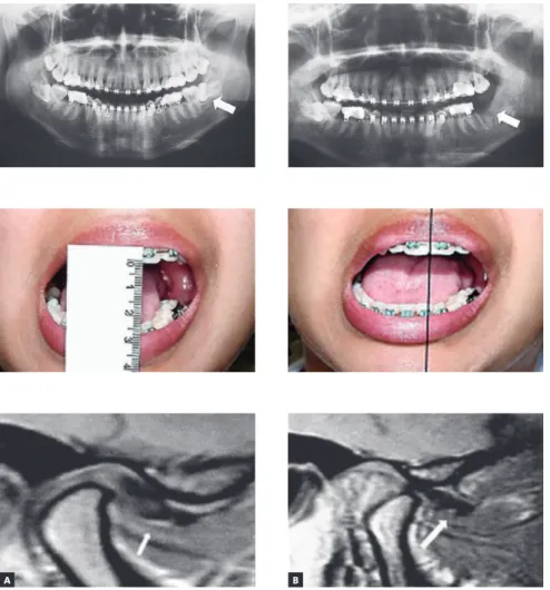 Figure 5 - A) Detail of MRI sagittal slice of the right  TMJ with mouth closed, evincing displacement of  the TMJ articular disc