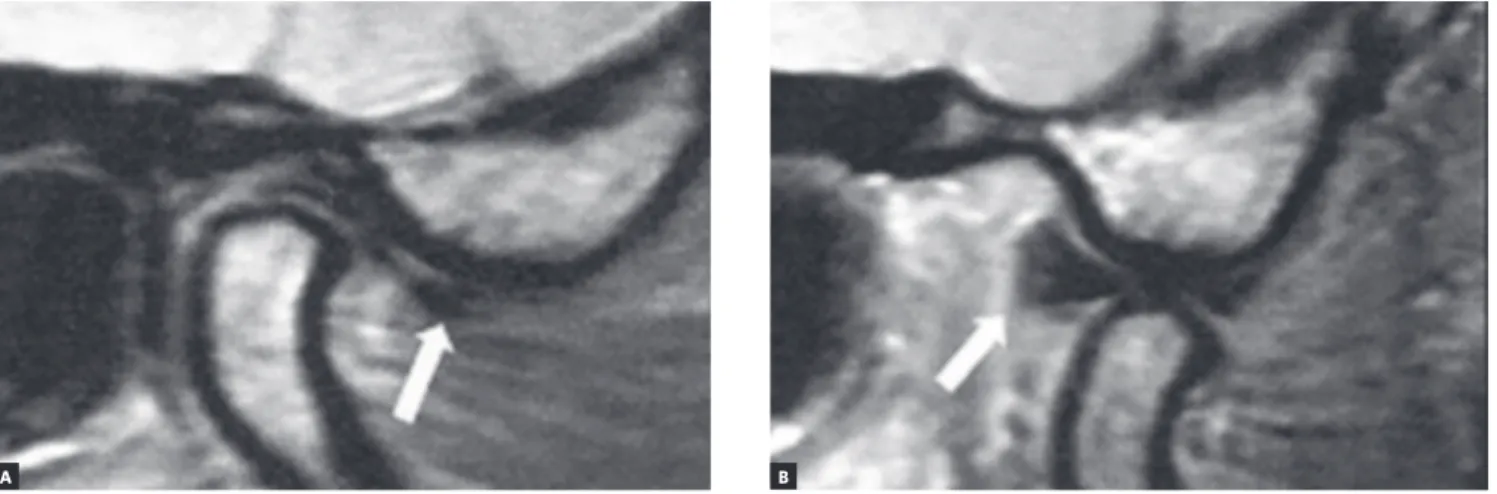 Figure 8 - A) MRI sagittal slice of the right TMJ with the mouth closed, evincing the persistence of TMJ articular disc displacement
