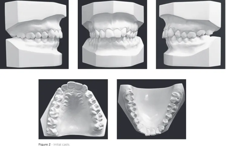 Figure 3 - Initial panoramic (A) and periapical radiographs of maxillary (B) and mandibular (C) incisors.