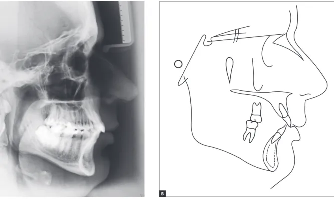 Figure 4 - Initial lateral cephalogram (A) and cephalometric tracing (B).